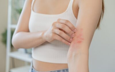 How to Treat Heat Rash in Children and Adults